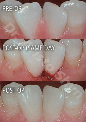 Patient 5 Before / After